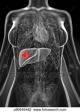 Drawing - Liver cancer, artwork. Fotosearch