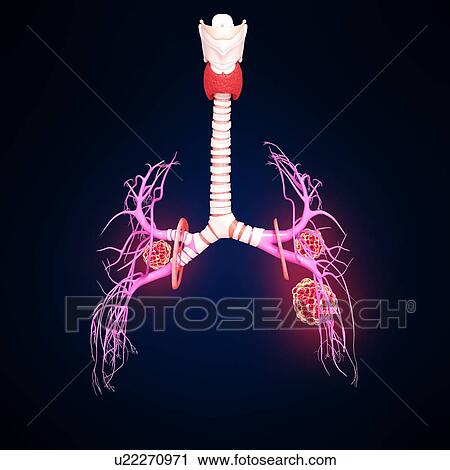 Lung cancer, artwork View Large Illustration Clip Art - Lung cancer, artwork. Fotosearch