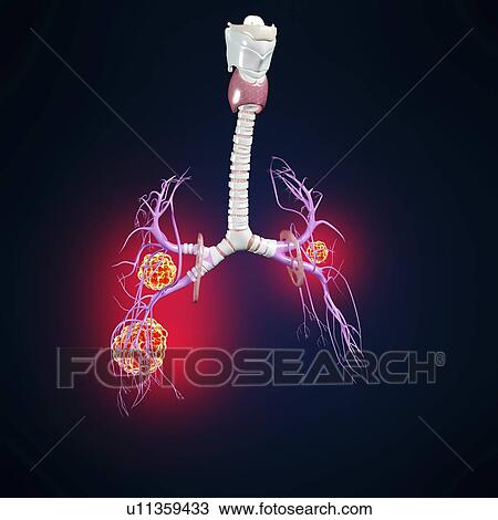 Drawing - Lung cancer, artwork. Fotosearch