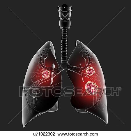 Drawing - Lung cancer, artwork. Fotosearch