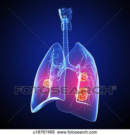 Stock Illustration - Lung cancer, artwork. Fotosearch