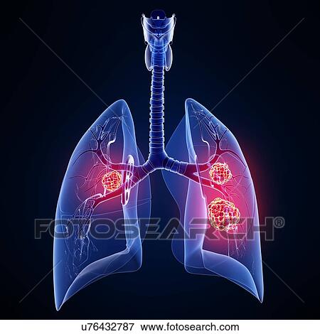Stock Illustration - Lung cancer, artwork. Fotosearch