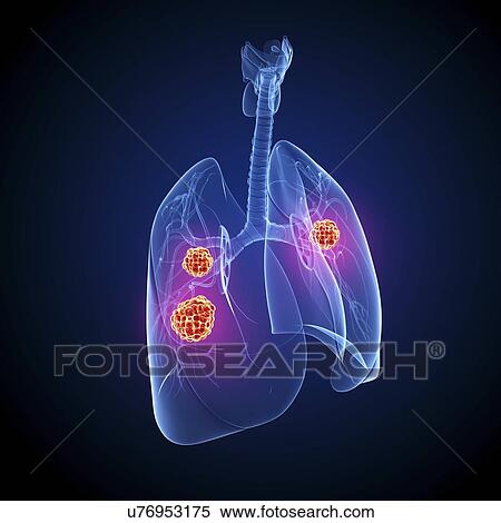 Stock Illustration - Lung cancer, artwork. Fotosearch