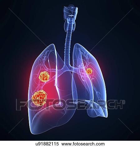 Lung cancer, artwork View Large Illustration Stock Illustration - Lung cancer, artwork. Fotosearch