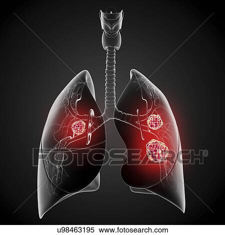 Lung cancer, artwork View Large Illustration Stock Illustration - Lung cancer, artwork. Fotosearch