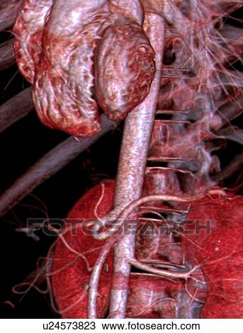Abdominal aorta, 3D CT scan View Large Illustration Drawing - Abdominal aorta, 3D CT scan. Fotosearch