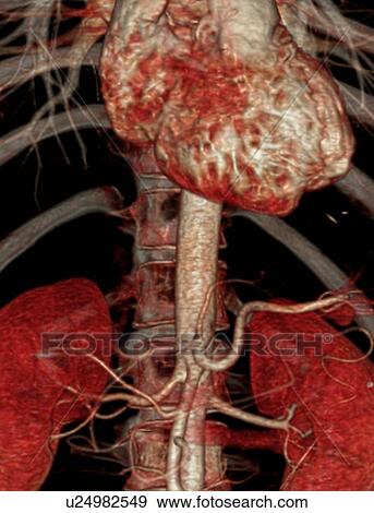 Abdominal aorta, 3D CT scan View Large Illustration Stock Illustration - Abdominal aorta, 3D CT scan. Fotosearch