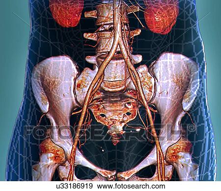 Abdominal aorta, 3D CT scan View Large Illustration Stock Illustration - Abdominal aorta, 3D CT scan. Fotosearch