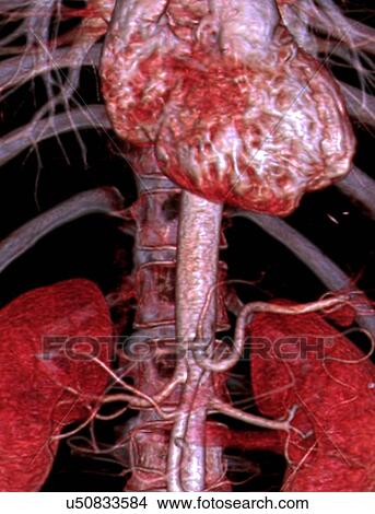 Abdominal aorta, 3D CT scan View Large Illustration Stock Illustration - Abdominal aorta, 3D CT scan. Fotosearch