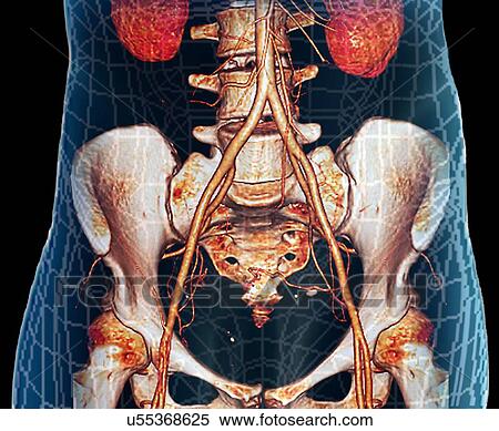 Abdominal aorta, 3D CT scan View Large Illustration Stock Illustration - Abdominal aorta, 3D CT scan. Fotosearch