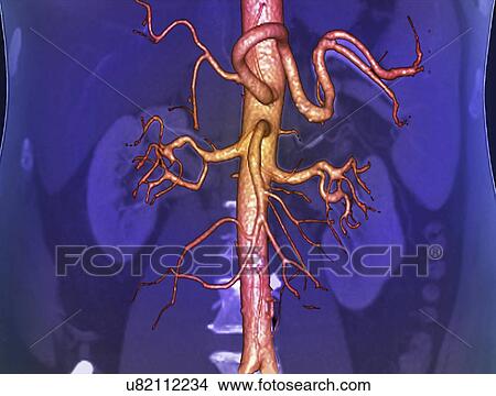 Abdominal aorta, 3D CT scan View Large Illustration Stock Illustration - Abdominal aorta, 3D CT scan. Fotosearch