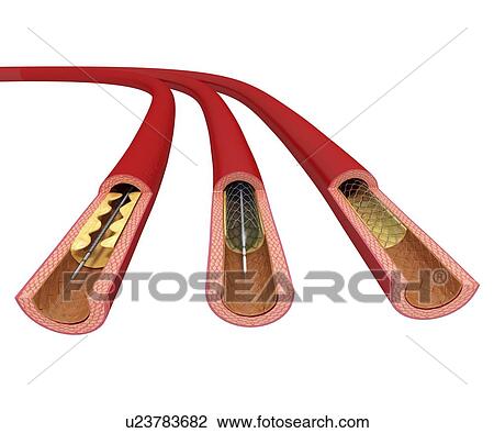 Angioplasty, artwork View Large Illustration Drawing - Angioplasty, artwork. Fotosearch