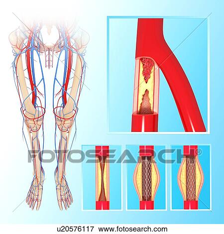Angioplasty, artwork View Large Illustration Stock Illustration - Angioplasty, artwork. Fotosearch