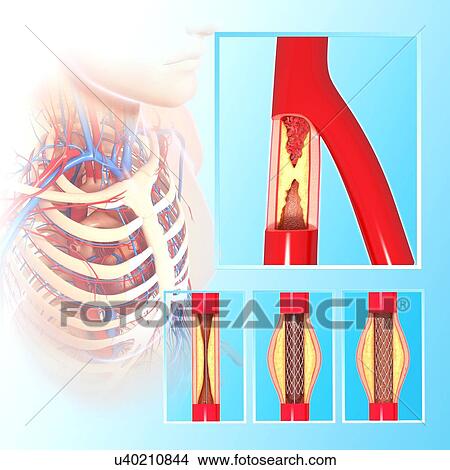 Stock Illustration - Angioplasty, artwork. Fotosearch