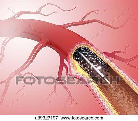 Angioplasty, artwork View Large Illustration Stock Illustration - Angioplasty, artwork. Fotosearch