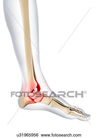 Ankle pain, conceptual artwork View Large Illustration Stock Illustration - Ankle pain, conceptual artwork. Fotosearch