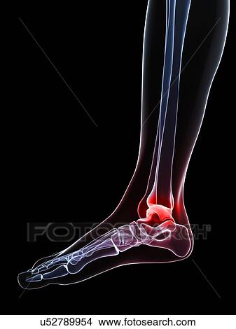 Stock Illustration - Ankle pain, conceptual artwork. Fotosearch