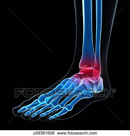 Ankle pain, conceptual artwork View Large Illustration Stock Illustration - Ankle pain, conceptual artwork. Fotosearch