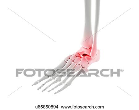 Stock Illustration - Ankle pain, conceptual artwork. Fotosearch