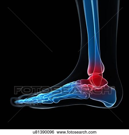 Ankle pain, conceptual artwork View Large Illustration Stock Illustration - Ankle pain, conceptual artwork. Fotosearch
