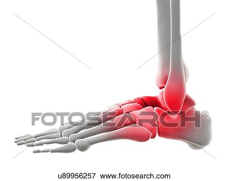 Ankle pain, conceptual artwork View Large Illustration Stock Illustration - Ankle pain, conceptual artwork. Fotosearch