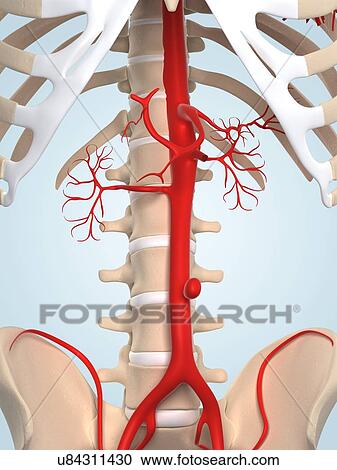 Aortic aneurysm, artwork View Large Illustration Clipart - Aortic aneurysm, artwork. Fotosearch
