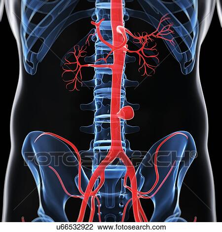 Aortic aneurysm, artwork View Large Illustration Drawing - Aortic aneurysm, artwork. Fotosearch