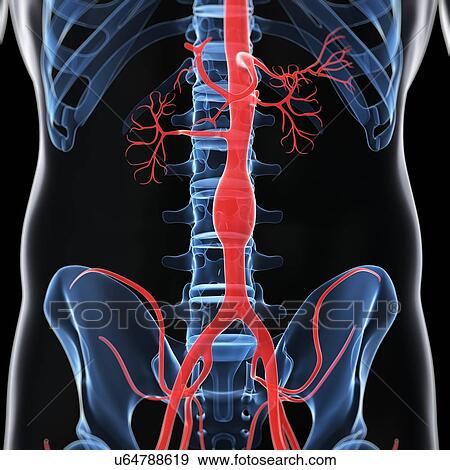 Aortic aneurysm, artwork View Large Illustration Stock Illustration - Aortic aneurysm, artwork. Fotosearch