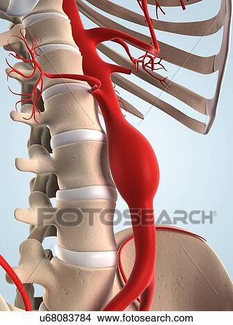 Stock Illustration - Aortic aneurysm, artwork. Fotosearch