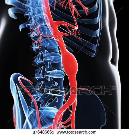 Stock Illustration - Aortic aneurysm, artwork. Fotosearch
