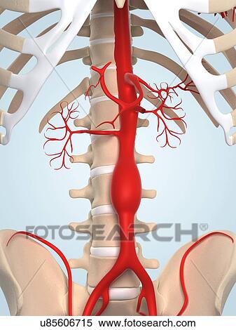 Stock Illustration - Aortic aneurysm, artwork. Fotosearch