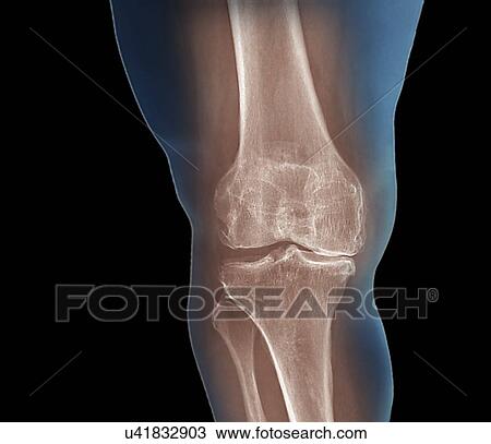Drawing - Arthritis of the knee, X-ray. Fotosearch