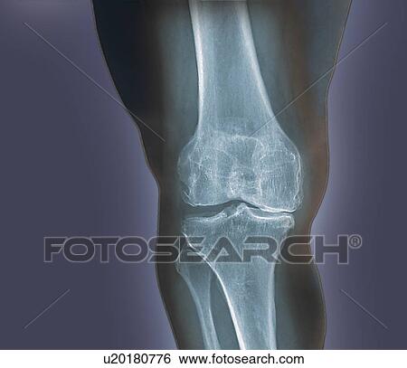 Arthritis of the knee, X-ray View Large Illustration Stock Illustration - Arthritis of the knee, X-ray. Fotosearch