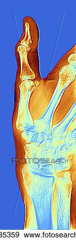 Stock Illustration - Arthrosis of the hand, X-ray. Fotosearch