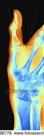Stock Illustration - Arthrosis of the hand, X-ray. Fotosearch