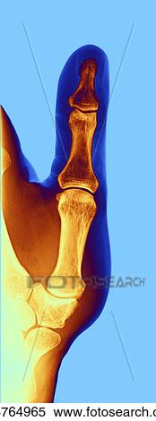 Stock Illustration - Arthrosis of the hand, X-ray. Fotosearch