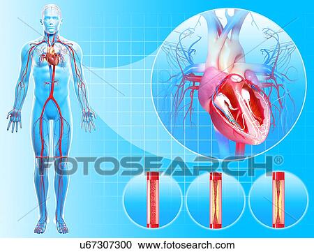Atherosclerosis, artwork View Large Illustration Clipart - Atherosclerosis, artwork. Fotosearch