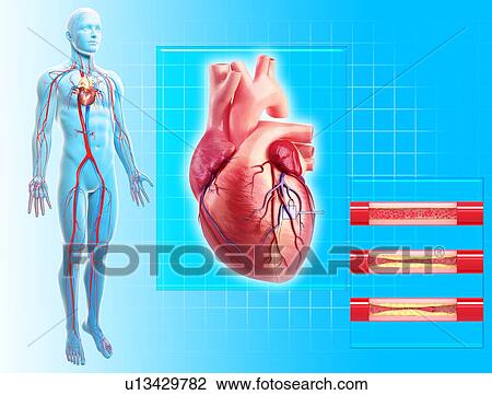 Atherosclerosis, artwork View Large Illustration Drawing - Atherosclerosis, artwork. Fotosearch