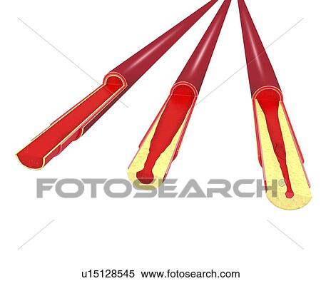 Atherosclerosis, artwork View Large Illustration Stock Illustration - Atherosclerosis, artwork. Fotosearch
