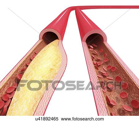 Atherosclerosis, artwork View Large Illustration Stock Illustration - Atherosclerosis, artwork. Fotosearch