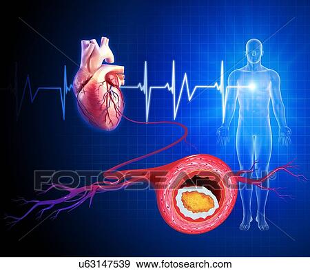Stock Illustration - Atherosclerosis, artwork. Fotosearch
