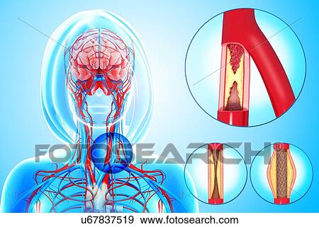 Atherosclerosis, artwork View Large Illustration Stock Illustration - Atherosclerosis, artwork. Fotosearch