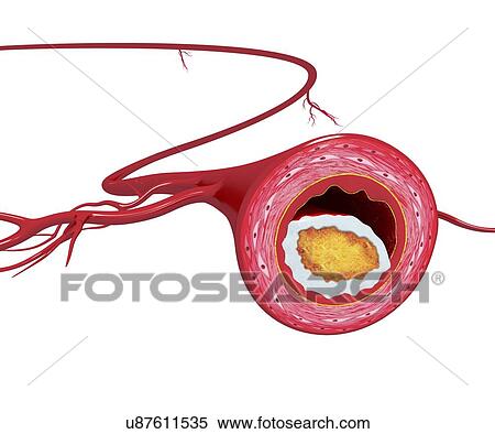 Stock Illustration - Atherosclerosis, artwork. Fotosearch