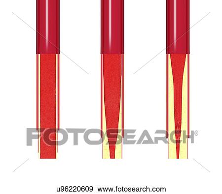 Stock Illustration - Atherosclerosis, artwork. Fotosearch