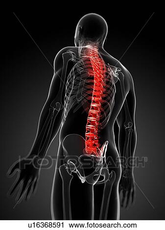 Clip Art - Back pain, conceptual artwork. Fotosearch