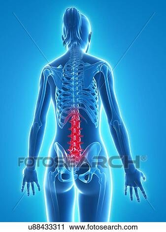 Clip Art - Back pain, conceptual artwork. Fotosearch