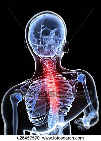 Back pain, conceptual artwork View Large Illustration Clipart - Back pain, conceptual artwork. Fotosearch