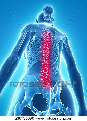 Back pain, conceptual artwork View Large Illustration Clipart - Back pain, conceptual artwork. Fotosearch