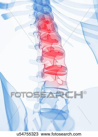 Back pain, conceptual artwork View Large Illustration Drawing - Back pain, conceptual artwork. Fotosearch