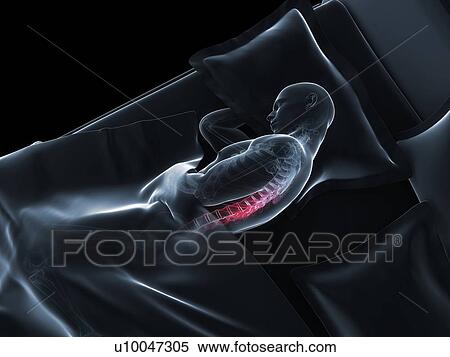 Stock Illustration - Back pain, conceptual artwork. Fotosearch